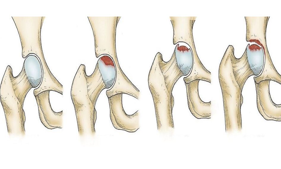 progression of hip pain