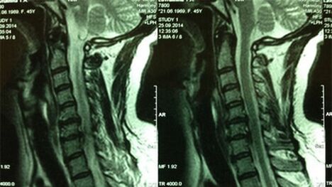 MRI of the cervical department