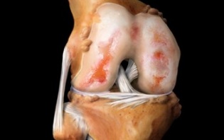 what is arthrosis of the knee