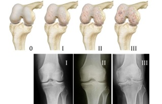 methods for diagnosing arthrosis of the knee