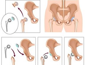endoprosthetics for arthrosis of the hip joint