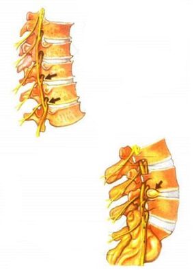 spine osteochondrosis illustration